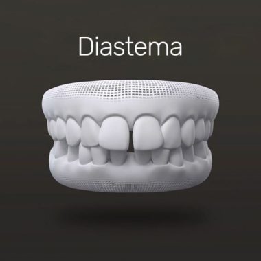 txt-invisalign-4 txt-invisalign-4