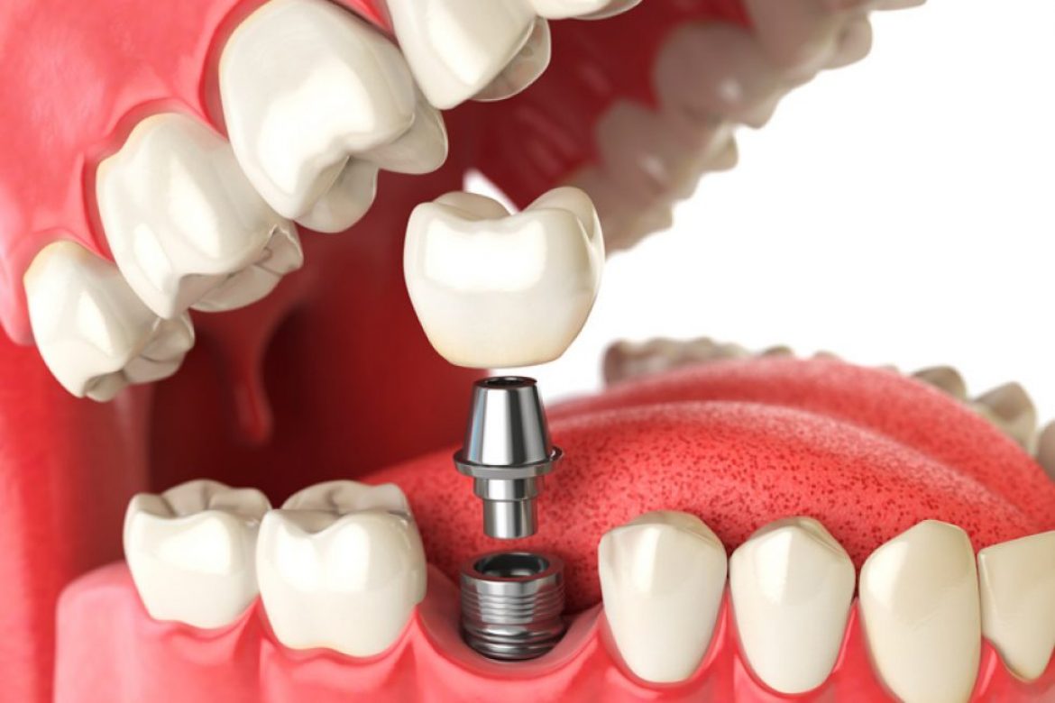 Implante Dental