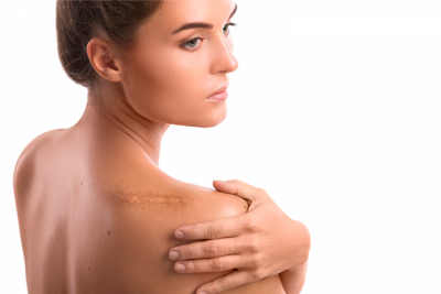 ¿Conoces los tipos de cicatrices?