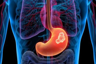 Septiembre: Mes del cáncer gástrico