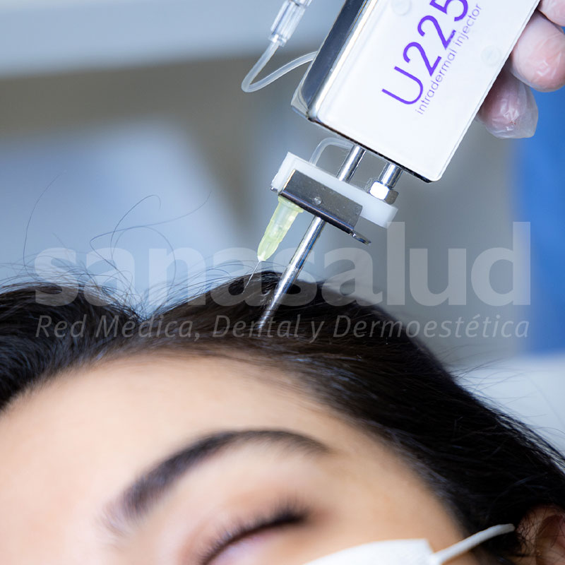 Mesoterapia capilar