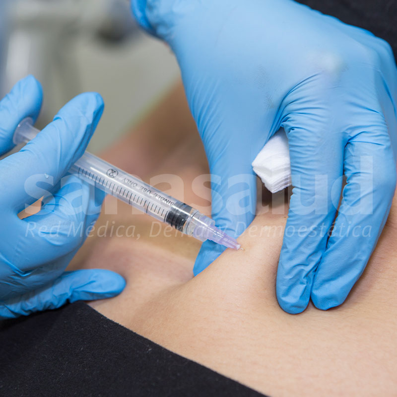 Mesoterapia corporal