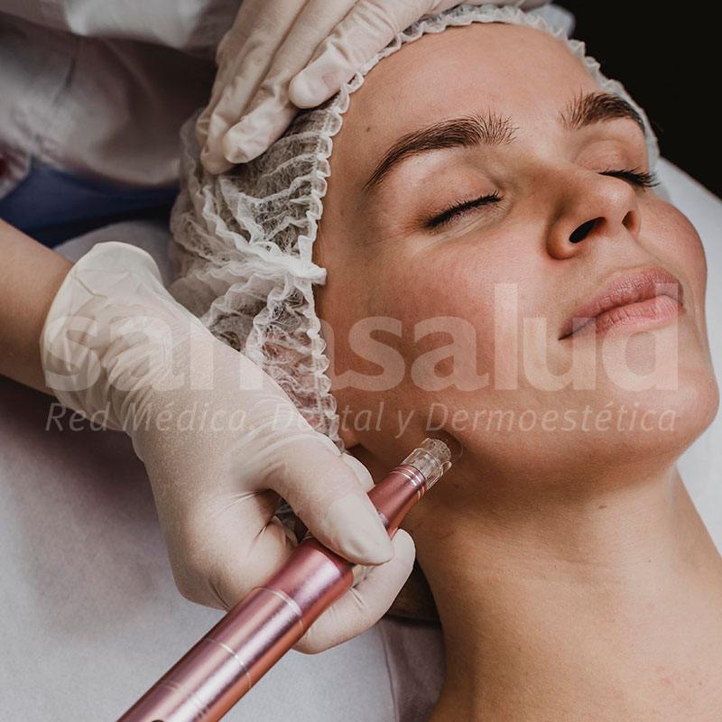 Microdermoabrasión