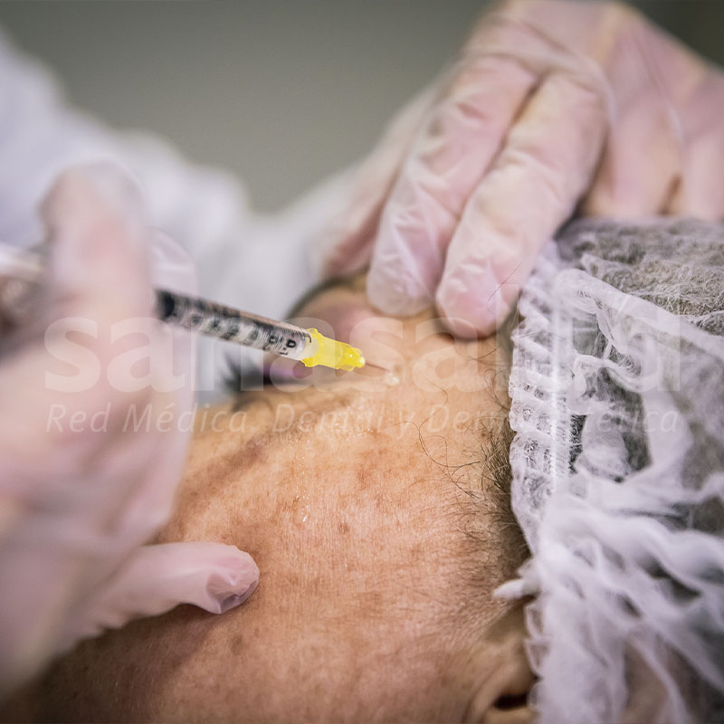 Botox ® 3 zonas